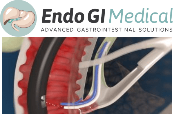 EndoGI Provides Better Future for Stenting Procedures